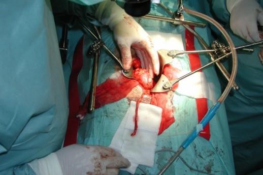 Američki tim stručnjaka obavio prvu uspješnu transplantaciju bubrega