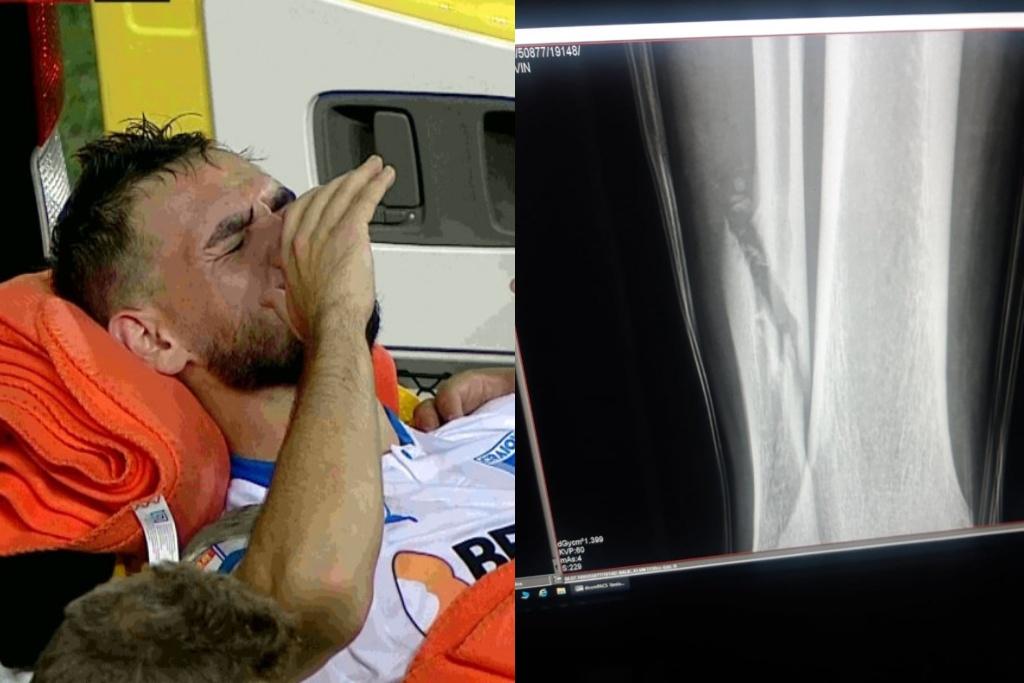 Snimci iz bolnice potvrdili katastrofalne vijesti, Koljiću slomljena noga
