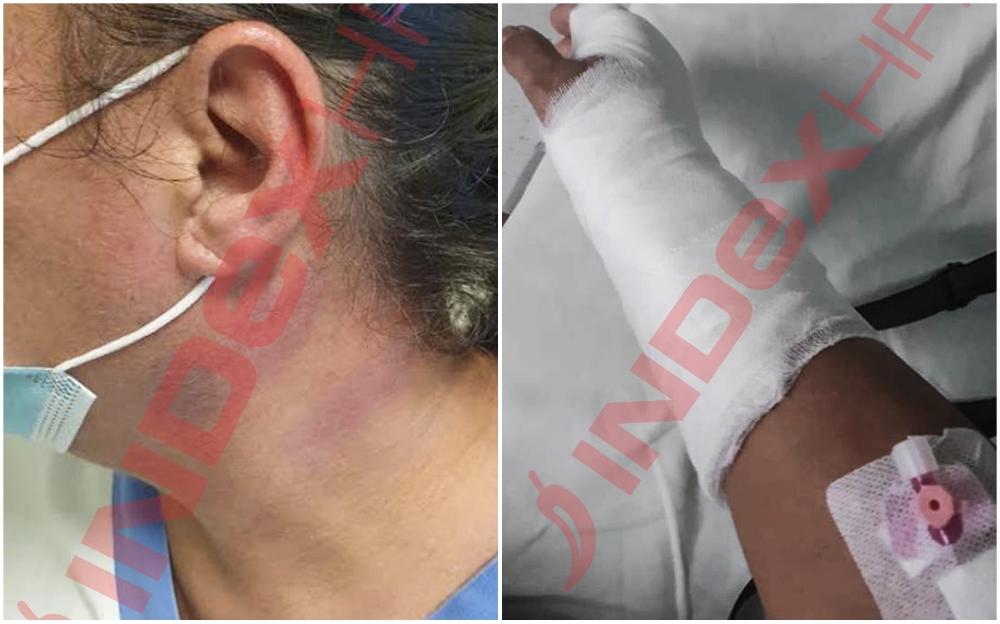 Muškarac brutalno napao i povrijedio medicinsku sestru zbog opravdanja za sina, davio je i slomio joj ruku