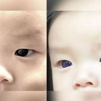 Oči bebe postale indigo plave nakon što joj je dat lijek protiv COVID-19